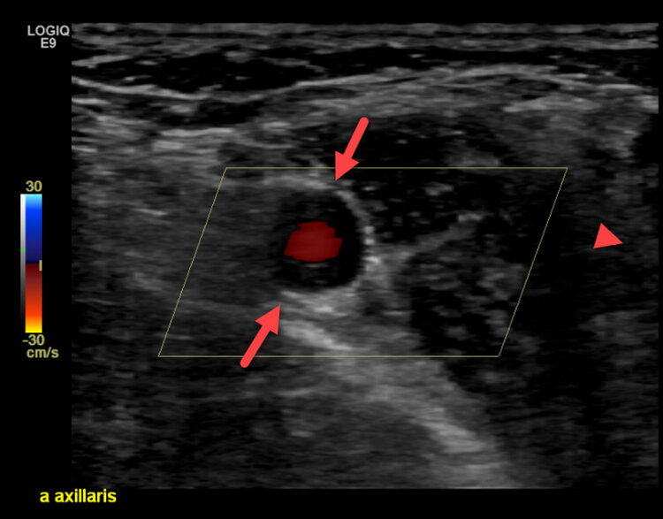 Riesenzellarteriitis der A. axillaris. Im
Querschnitt («Halo-Phänomen»). 
(Mit freundlicher Unterstützung S. Klein/ J.
Dopheide STS AG Thun.)