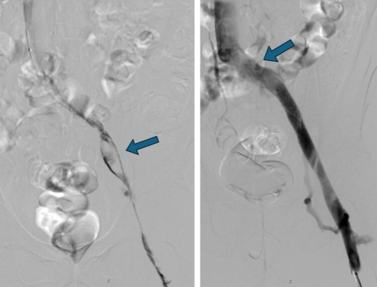 a) Beckenvenenthrombose (Pfeil) vor Thrombusentfernung mittels medikamentöser (Lyse) und katheterunterstützter Thrombektomie. b) Nach Thrombusentfernung einschliesslich Stenting (Pfeil) bei sog. May-Thurner-Syndrom (venöses Kompressionssyndrom der Beckenvenen).
