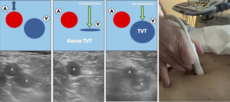 Kompressionsultraschall zur Diagnostik einer tiefen Beinvenenthrombose. a) Ausgangsbefund mit (A) Arterie und (V) Vene. b) Wenn die Venen (V) zusammengedrückt werden kann, liegt keine Thrombose vor. c) keine Kompression der Vene (V) möglich, somit kann die Diagnose einer tiefen Beinvenenthrombose gestellt werde. 