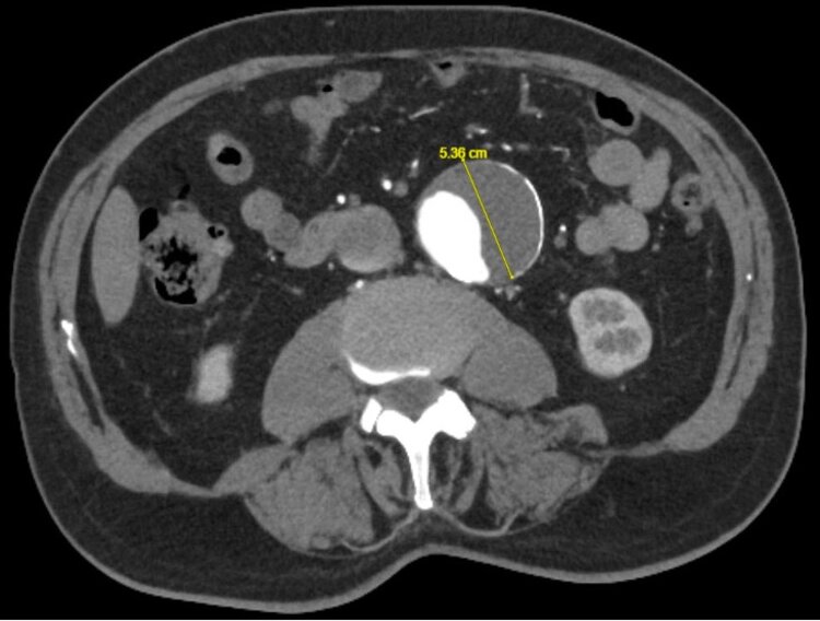 Mittels Schnittbildgebung kann in dann bei sonographischen Auffälligkeiten resp. Grössenzunahme der Aorta eine genaue und achsengerechte Darstellung der Aorta erfolgen.