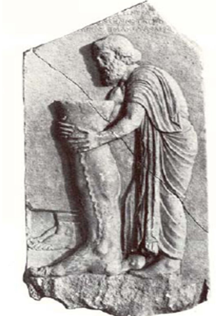 Schon im Altertum waren Krampfadern als Ursache eines «schweren» Beins bekannt (älteste bekannte Darstellung der Varikosis, 4. Jahrhundert v. Chr., Akropolis Athen, archäologisches Nationalmuseum Athen, Griechenland – dem Doktor AMYNOS gewidmete Gedenktafel). 