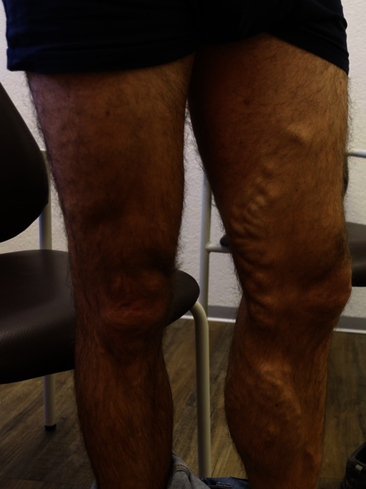 Oft kommt es zu varikösen Veränderungen der Hauptstammvenen V. saphena magna mit ihren Seitästen. Dies sollte zur Beschwerdelinderung und Verhinderung von Kopmplikationen zeitnah behandelt werden.