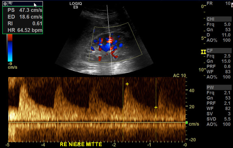 Duplexsonographische Messung der Nierendurchblutung