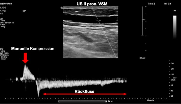 Darstellung der V. saphena magna (VSM) im Längschnitt mittels Ultraschall. Unter Doppler-sonographischer Ableitung des Venenflusses, kann hier durch manuelle Kompression am Unterschenkel der Rückstrom in der Venen durch die undichten (insuffizienten) Venenklappen ersichtlich gemacht werden.