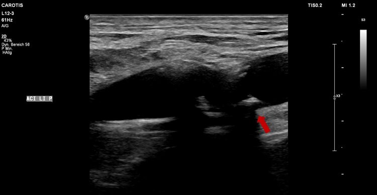 Duplexsonographische Darstellung einer Einengung der Halsschlagader.