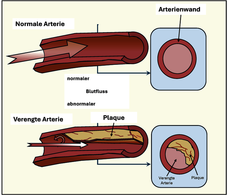 In einem normalen Gefäss mit glatter Gefässwand kann das Blut ungehindert fliessen. Eine Plaque (Fettreiche Verkralkung) kann weiter wachsen und den Blutfluss erschweren oder verhindern. Die Folge sind Herzinfarkt, Schlaganfall oder schwere Durchblutungsstörungen der Beine (Schaufensterkrankheit).